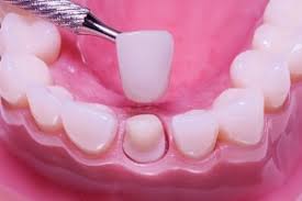 پروپوزال پروتزهای دندانی